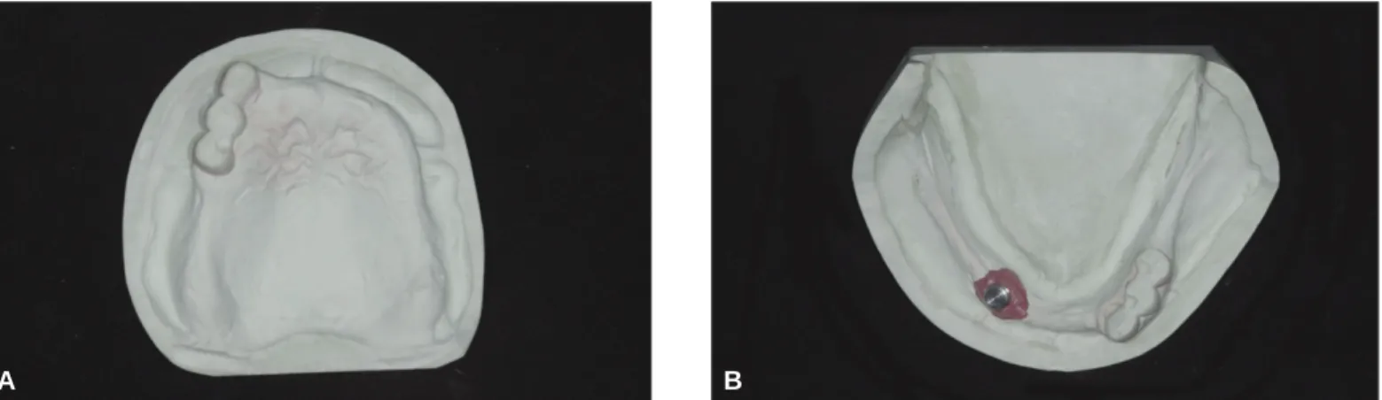 Fig. 3. Master cast fabrication. A: Upper master cast, B: Lower master cast with Locator male connection.