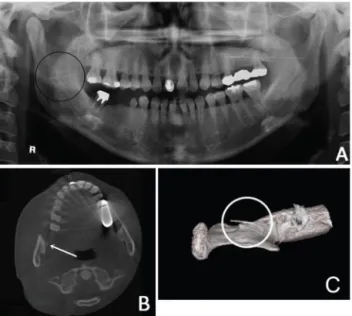 Fig. 1. Preoperative radiographic images showing the broken needle in (A) panoramic view, (B) computed tomography (CT) axial view, and (C) as a 3D-CT image.