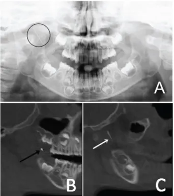 Fig. 3. Preoperative radiographic images showing the broken needle and  gutta-percha.  (A) Broken dental needle in panoramic view, and a computed tomography (CT) sagittal view of the (B) gutta-percha and (C) broken dental needle.