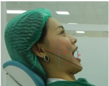 Fig. 1. The angulations of lower third molars in this study.