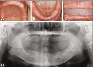 Fig. 1. Pre-operative intraoral view (A, B and C) and panoramic radiograph (D) after 3-month extraction.