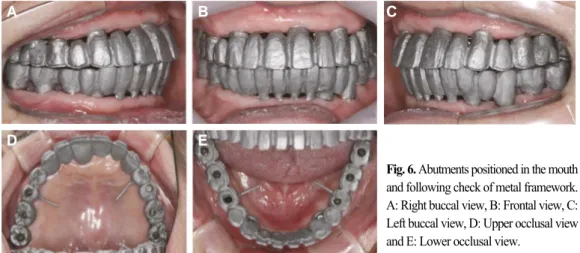 Fig. 6. Abutments positioned in the mouth and following check of metal framework.