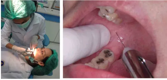 Fig. 1. The standard IANB injection technique.