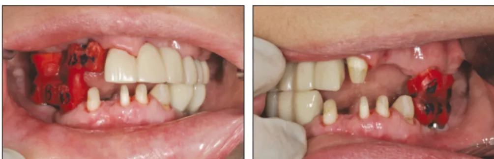 Fig. 11. Provisional restoration. Fig. 12. Bite registration. Pattern resin copings which were relined by bite material at one side were connected remaining provisional restorations at the other side and vice versa