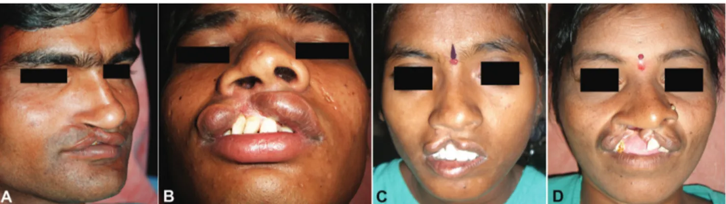Fig. 3. Representative cases of cleft lip repair in adult patients under regional anesthesia