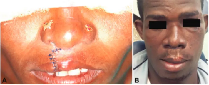 Fig. 5. Clinical appearance of a cheiloplasty performed with only regional anesthesia immediately after surgery (A) and after six months (B).