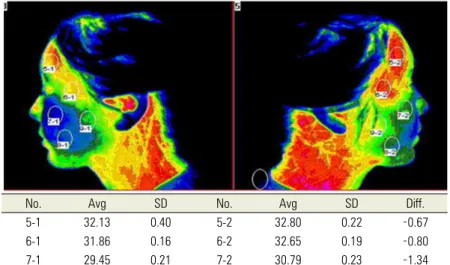 Fig. 1. Thermography showed that the temperature was significantly lower in the left maxillary area than the right maxillary area.