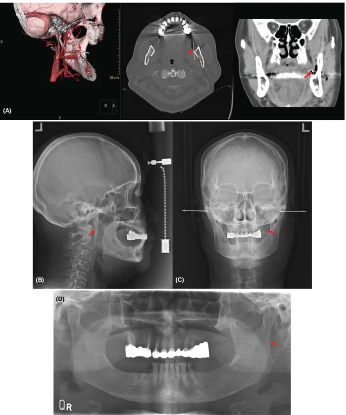 Fig. 1. Preoperative radiographic image illustrating the broken needle: (A) 3D computerized tomography, (B) lateral skull view, (C) posterior-anterior skull view, (D) panoramic view.