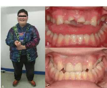 Fig. 1. (A) Characteristic facial features including narrow forehead, thin upper vermillion, and downturned corners of the mouth were observed.
