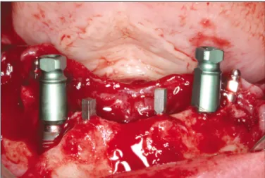 Table 1. Datum of patients and implants Patient 