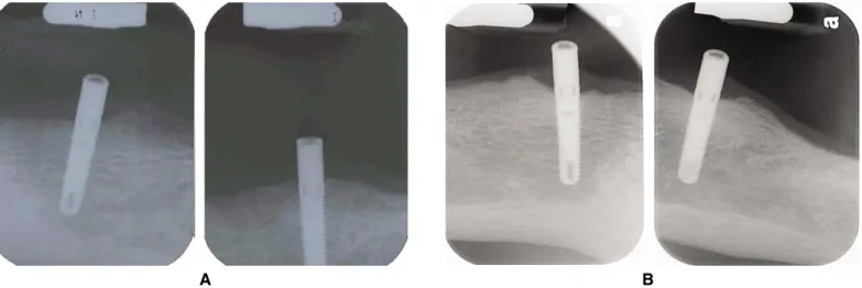 Fig. 5. A: Periapical radiograms after delivery of final denture, B: Periapical radiograms after 6.5 years show minimal bone loss around implants.