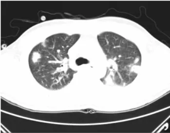 Fig. 1. Panoramic view exhibiting root rest of the left mandibular  first  molar  as  the  infection  origin.