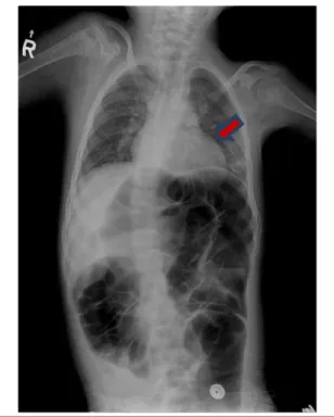 Fig. 3. Preoperative  evaluation  (Chest  X-ray)  showes  subsegmental atelectasis on her left lower lobe of lung.