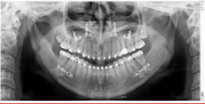 Fig. 1. Radiograph after Le Fort I osteotomy with differential  reduction and mandibular setback sagittal split ramus  osteotomy  with  angle  reduction.