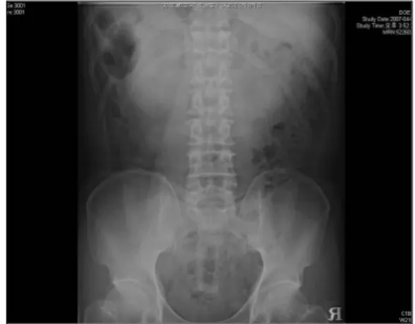 Fig.  4.  Abdominal  x-ray  after  7  days.  The  amalgam  core  material  is  no  more  seen.
