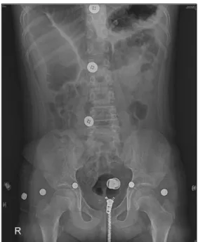Fig.  5.  Panoramic  radiograph  of  case  2.  Mild  crow- crow-ding  on  anterior  teeth  are  noted