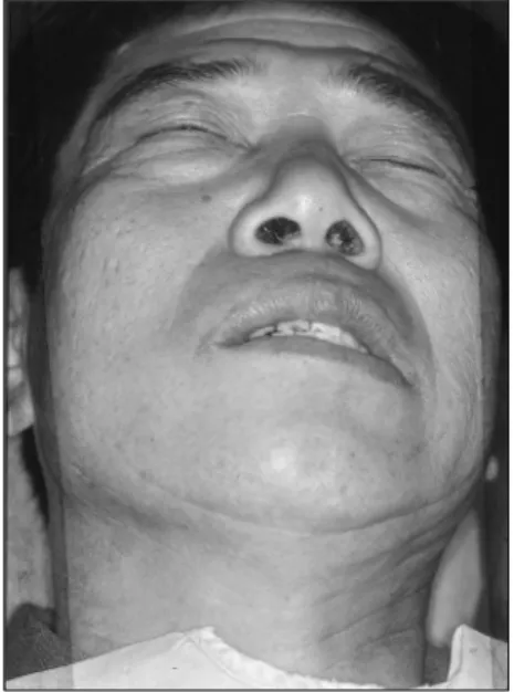 Fig.  1.  Initial  view  of  facial  palsy.