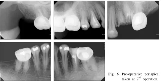 Fig.  6.  Pre-operative  periapical  views  taken  at  2 nd   operation. 술과  달리  두번째  수술에서는  기관절개관을  통해  산소가  계속  공급되고  있는  상황이었고  목으로  넘 어가는  혈액을  제거하면  산소포화도가  양호하게  유 지되는  것으로  보아  기도로  넘어가는  구강분비물과  혈액에 의한 호흡부전으로 추측되었다