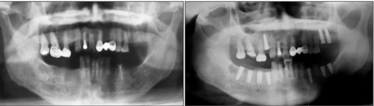 Fig.  1.  (A)  Preoperative  panoramic  image  was  taken.  (B)  Postoperative  panoramic  image  was  taken.