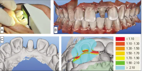 Fig. 3. A: iTero digital impression, B: Scanned image, C: Evaluating the amount of reduction and shape of prepared tooth.