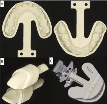 Fig. 6. All ceramic crown by conventional method (A), by digital method (B).