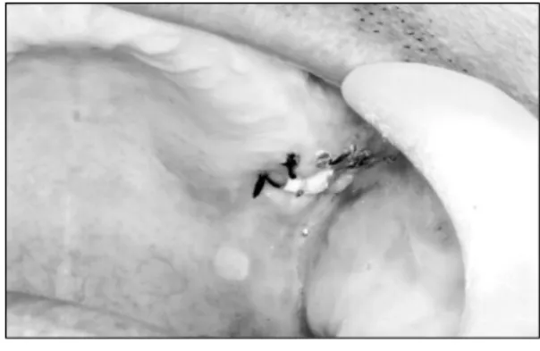 Fig.  2.  Bleeding  control  view  of  extraction  socket  with  circumferential  suture  and  iodoform  gauze  drainage