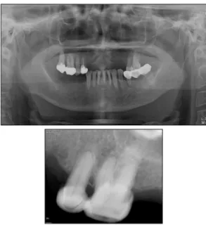 Fig.  1.  Initial  panoramic,  periapical  view  of  case  1. 