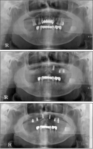 Fig.  2.  Panoramic  image  of  case  2.  Multiple  hopeless  teeth  are  noted.