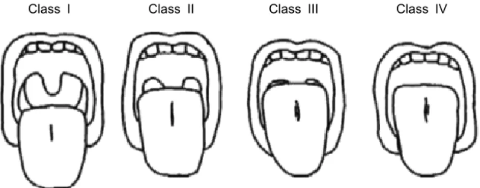 Fig.  1.  The  Samsoon-Young  modification  of  the  Mallampati  airway  classification
