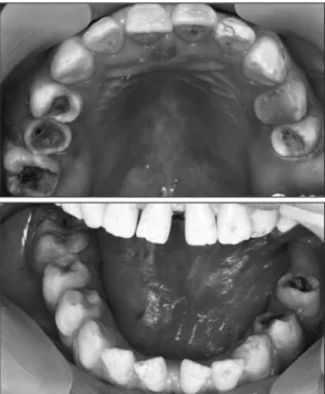 Fig.  1.  Pre-treatment  oral  state.의  평가가  불가능한  장애인  환자에서  전신마취는 다른  정상인  환자보다  더  호흡기  감염의  위험도가 높을  수  있으나,  그  평가가  쉽지  않다