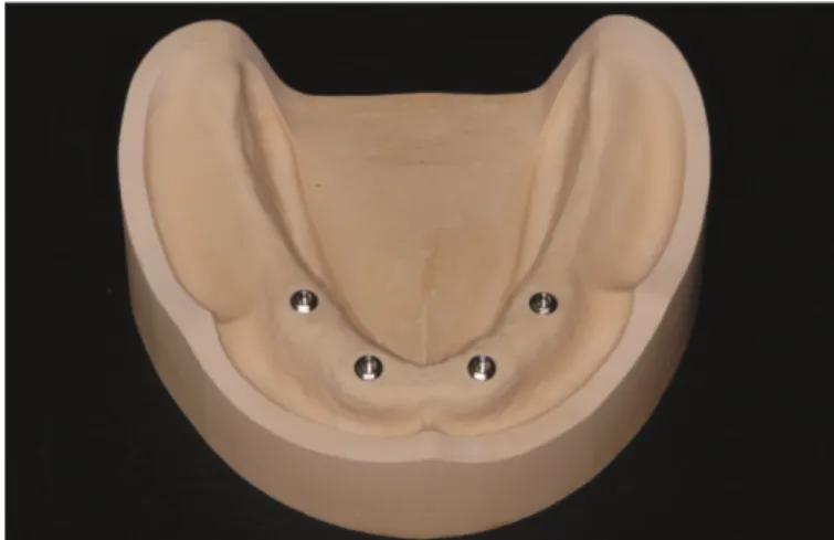 Fig. 2. Non-splinted impression technique.