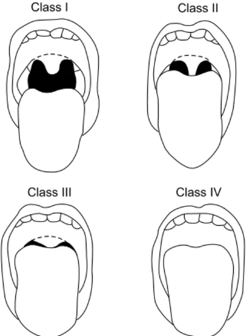 Fig.  2.  Classification  of  the  upper  airway  in  terms  of  the  size  of  the  tongue  and  pharyngeal  structures  visible  upon  mouth  opening