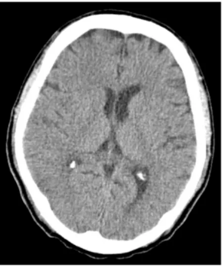 Fig.  1.  Coronal  view  of  brain  CT  images,  taken  imme- imme-diately  postoperative,  shows  mild  edematous  changes  in  the  right  cerebral  hemisphere.