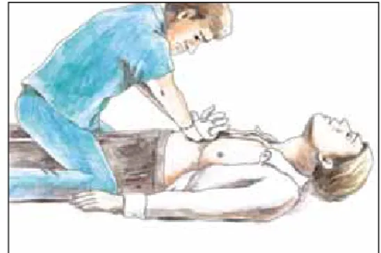 Fig.  5.  Subdiaphragmatic  abdominal  thrust  (Heimlich  maneuver),  victim  standing.