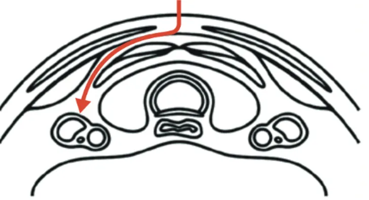 Fig. 4. Access to the VN, medially to the strap muscle and laterally to the thyroid gland