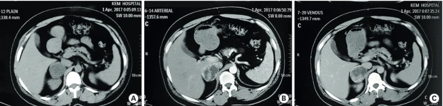 Fig. 1. CT of abdomen. (A) A non-contrast enhanced CT scan showing a large encapsulated right adrenal lesion with regular margin