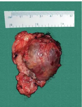 Fig. 2. Adrenalectomy specimen: 6.0×5.5×2.5 cm gross adrenal specimen.