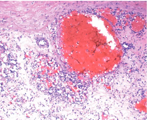 Fig. 4. Light microscopic image of adrenal hemangioma. Multiple dilated interconnecting vascular channels with  thrombosis (hematoxylin and eosin staining, ×40).