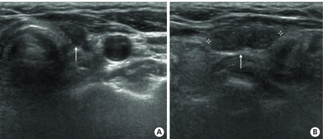 Fig. 1. Ultrasonographic image of artificial ADM. (A) Ultrasonographic image showed a hypoehoic mass on the left  thyroid operation bed, which is 1.5×1.6 cm in size on transverse view (arrow)