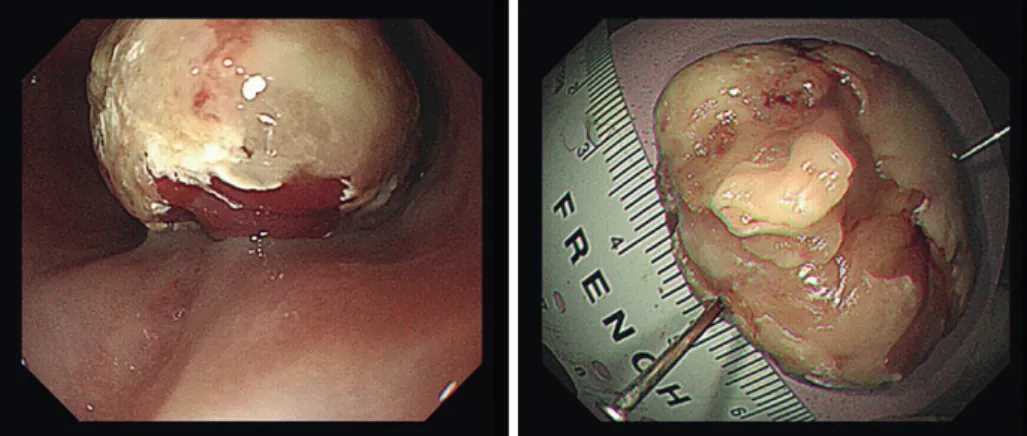 Fig. 3. Endoscopic evaluation of luminal protruding mass in esophagus.