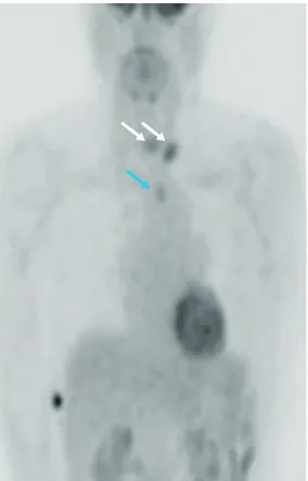 Fig. 5. PET-CT scan. Uptake of post-thyroidectomy site recurrent lymph node (white arrow) and esophageal  metastasis (blue arrows)