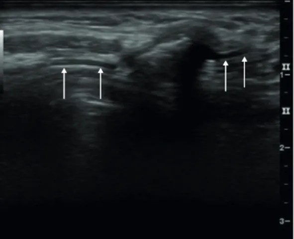 Fig. 1. The longitudinal neck ultrasonography shows a hypoechoic lesion with internal echogenic parallel lines  (arrows), suggesting a retained drainage tube.