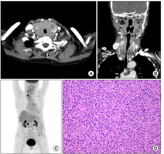 Fig. 2. A  79-year-old  woman  who  was  diagnosed  with  diffuse  large  B-cell  lymphoma