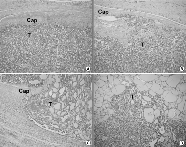 Fig. 1. Histologic  types  of  follicular  variant  of  papillary  thyroid  carcinomas