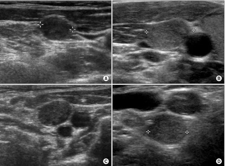 Fig. 1. Ultrasound images of central lymph node metastasis. (A) LNM with a loss of normal hilar echogenicity; (B) LNM with long diameter (＞5 mm) and increased echogenicity; (C) LNM with round shape; (D) LNM with extracapsular metastasis