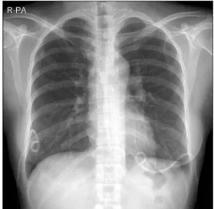 Fig. 1. Chest  X-ray  shows  bilateral  pleural  effusion  (Fourth  postoperative day).