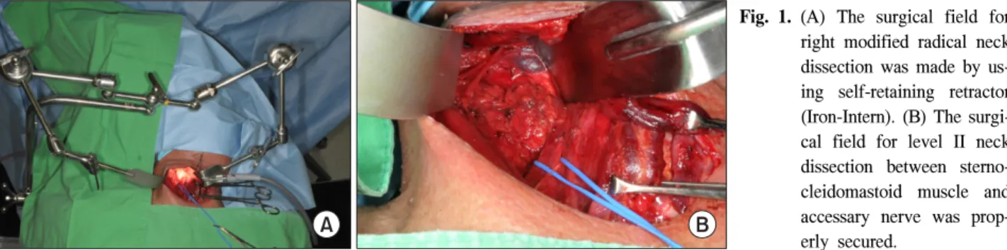 Fig. 1. (A)  The  surgical  field  for  right  modified  radical  neck  dissection  was  made  by   us-ing  self-retainus-ing  retractor  (Iron-Intern)