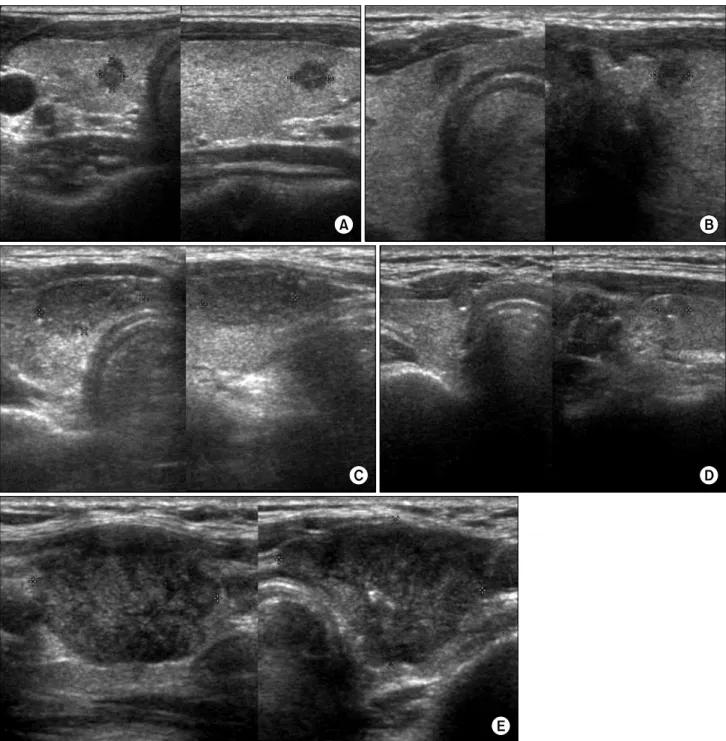 Fig. 1. Contact grade and capsule disruption on USG in papillary thyroid carcinoma. (A) A 32-year-old man without capsule contact and  disruption
