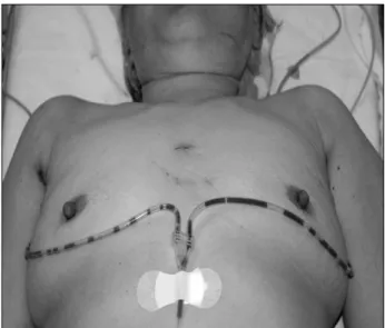 Fig. 3. Postoperative  scar  immediate  after  bilateral  robotic  modi- modi-fied  radical  neck  dissection  (MRND)  in  papillary  thyroid  carcinoma  (PTC)  patient  showing  bilateral  lateral  neck  node  metastasis