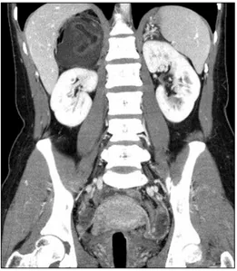 Fig. 1. Abdominal  CT  finding  of  a  mature  cystic  teratoma  mimi- mimi-cking  an  adrenal  tumor